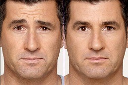 Best Botox Injection for Male Dubai