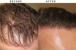 Best Clinic of Finasteride for Hair Loss Dubai