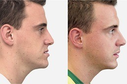 Best Clinic of Jaw Surgery Cost in Dubai