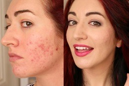 Best Clinic of Laser Treatment For Acne Scars Cost Dubai