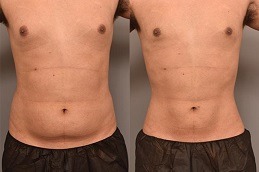 Best Clinic of Liposuction Surgery Cost in Dubai
