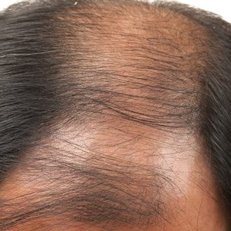Best Dermatologist for Hair Loss in Dubai UAE