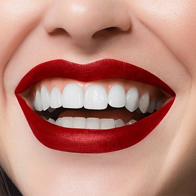 Best Hollywood Smile Makeover in Dubai & Abu Dhabi Smile Makeover Cost