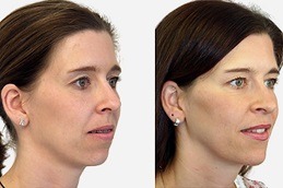 Best Jaw Surgery Cost in Dubai
