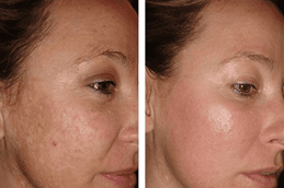Best Laser Treatment For Acne Scars Cost in Dubai