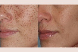 Best Pigmentation Treatment in Dubai