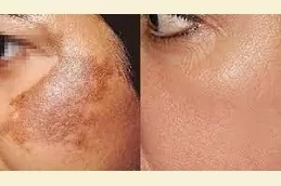 Pigmentation Treatment in Dubai