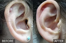 Best Scars & Keloid Treatment Clinic in Abu Dhabi