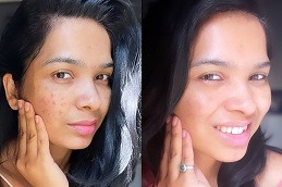 Best Skin Whitening Injection Price in Dubai