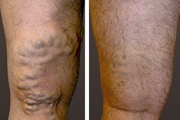 Best Varicose Veins Treatment in Dubai