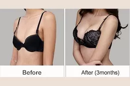 Breast Augmentation Clinic in Abu Dhabi