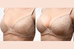Breast Augmentation Clinic in Dubai