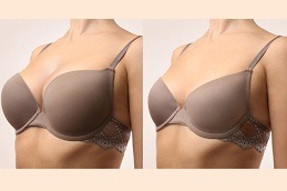 Breast Augmentation in Abu Dhabi