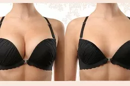 Breast Augmentation in Dubai