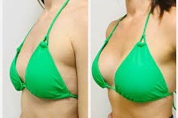 Breast Enlargement Injections Dubai