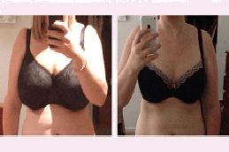 Breast Reduction Dubai