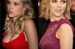 Breast Reduction in Dubai