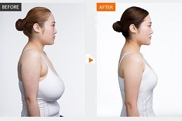 Breast Reduction treatment in Dubai