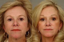 Eye Bag Removal Abu Dhabi