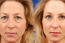 Eye Bag Removal in Abu Dhabi