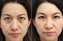 Eye Bag Removal in Dubai, Abu Dhabi & Sharjah