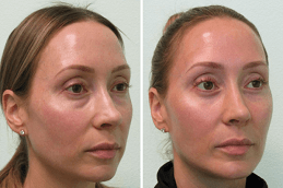 Eye Bag Removal in Dubai