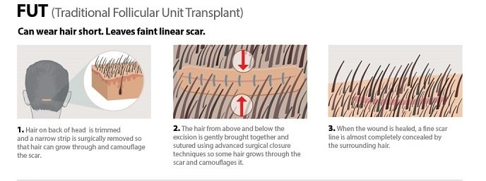 FUT Hair Transplant in Dubai UAE