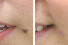 Facial Mole Removal Abu Dhabi