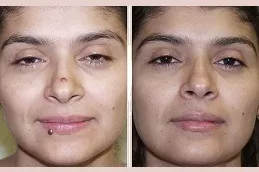 Facial Mole Removal Clinic Dubai