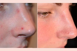 Facial Mole Removal Clinic in Dubai