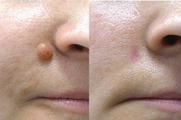 Facial Mole Removal Dubai