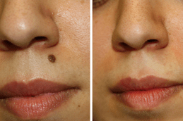Facial Mole Removal in Abu Dhabi