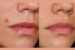Facial Mole Removal in Dubai & Abu Dhabi