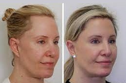 Female Hair Transplant Clinic in Dubai