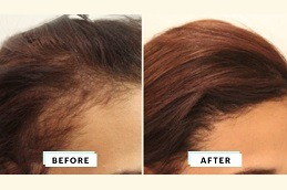 Female Hair Transplant Dubai