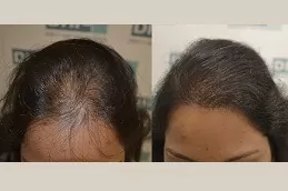 Female Hair Transplant in Abu Dhabi