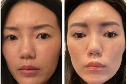 Fox Eye Thread Lift Dubai & Abu Dhabi