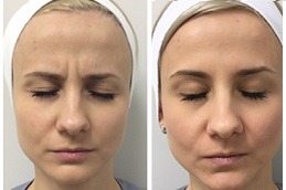 Fox Eye Thread Lift in Abu Dhabi