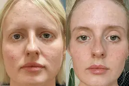 Fox Eye Thread Lift in Dubai