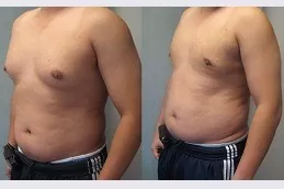 Gynecomastia in Dubai