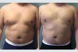 Gynecomastia Surgery in Dubai