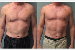 Gynecomastia Surgery Dubai