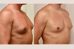 Gynecomastia Surgery Clinic in Dubai