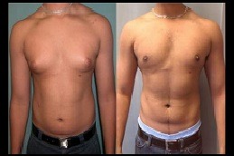 Gynecomastia Surgery in Dubai