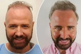 Hair Replacement Abu Dhabi