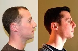 Hair Replacement Clinic in Dubai