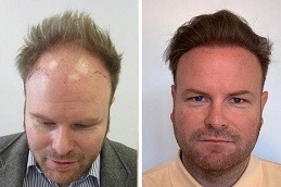 Hair Replacement Dubai