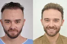 Hair Replacement in Abu Dhabi