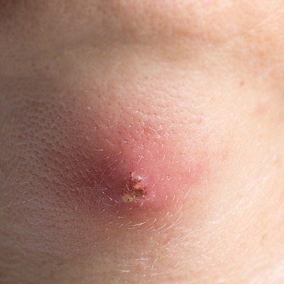 Incision and Drainage of Abscesses in Dubai & Abu Dhabi Drainage Dubai