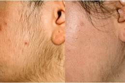Is It Haram To Do Best Clinic of Laser Hair Removal in Dubai